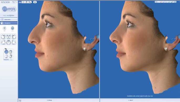 Vectra M3 3D rhinoplasty simulation system developed by Canfield Scientific. Dr.Mireas. hump removal. Side-by-side before and after comparison