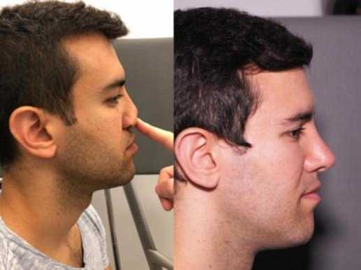 Left Failed rhinoplasty with lack of nasal tip support and bad nasal breathing Right 6 days after revision surgery