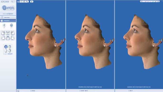 Vectra M3 3D rhinoplasty simulation system developed by Canfield Scientific. Dr.Mireas. hump removal. Side-by-side before and after comparison in two versions
